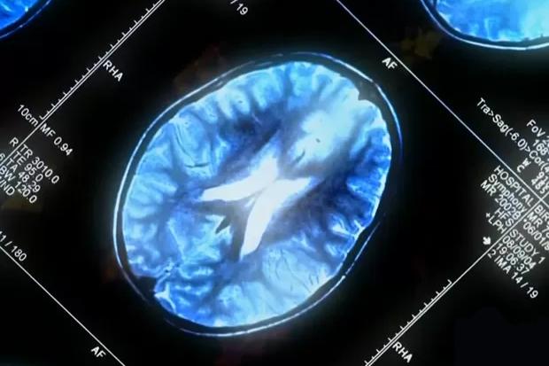 Terapia experimental contra Alzheimer mostra resultado promissor